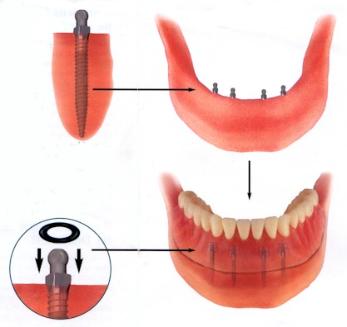 mini implant2